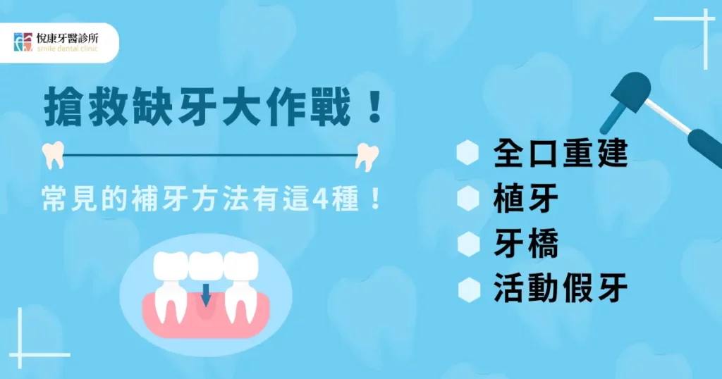 搶救缺牙大作戰！常見的補牙方法有這 4 種！